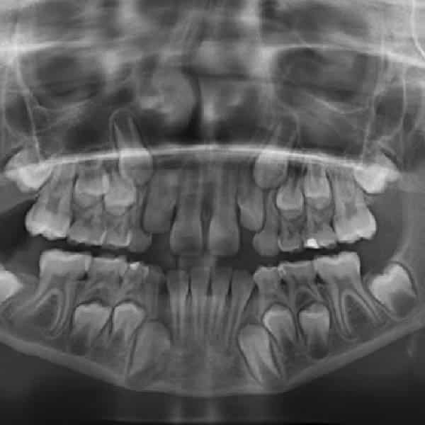 radiografia dientes ortodoncia
