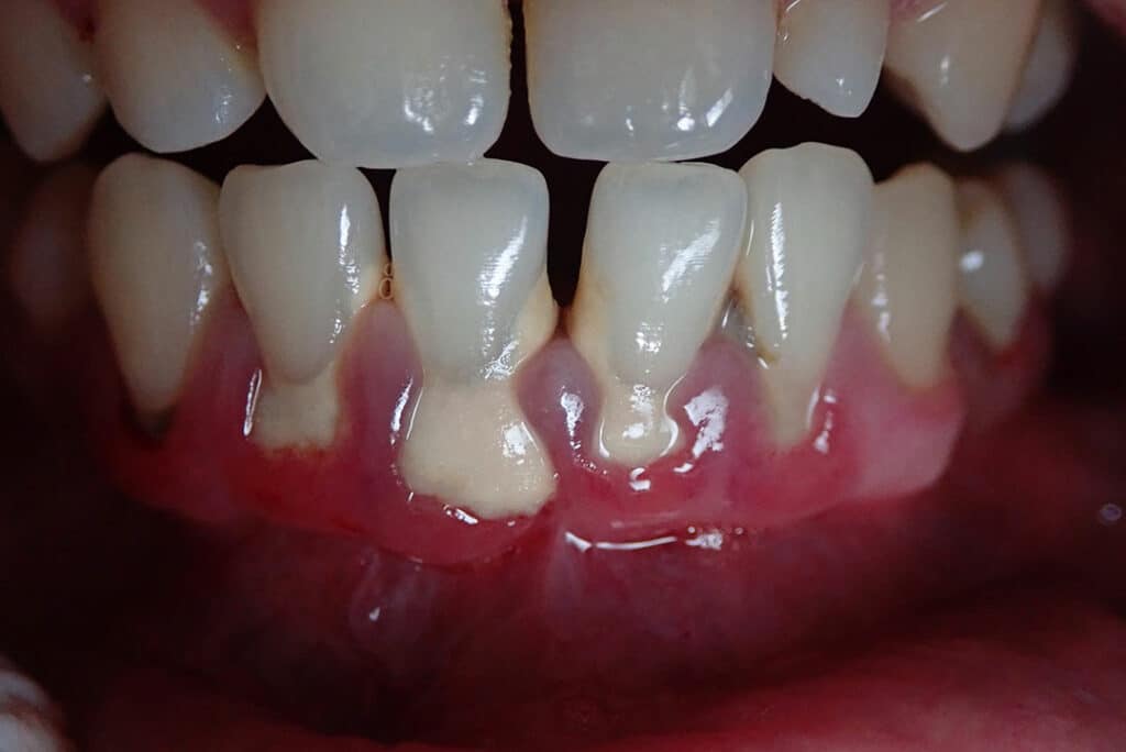 Enfermedades de periodoncia que tratamos en Domus Dental