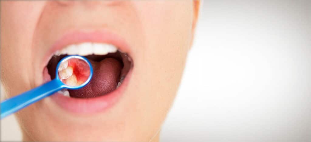 Tratamiento de gingivitis en A Coruña en clínica especializada