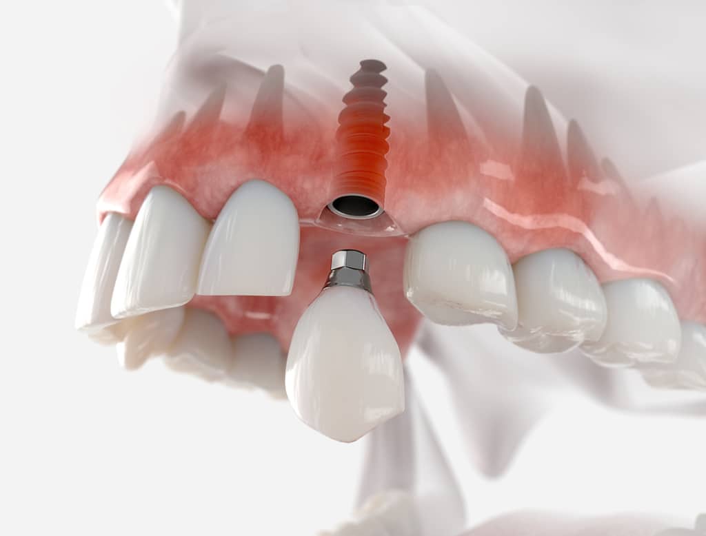 Implantes dentales en A Coruña Sin esperas ni dolor