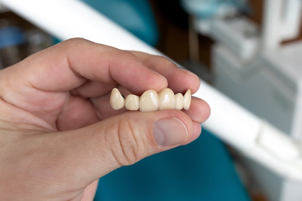 ¿Cuándo es conveniente colocar una corona dental?
