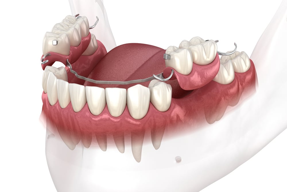 Cuáles son los tipos de prótesis dentales que hay