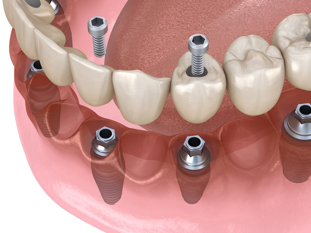 Tipos de protesis dentales