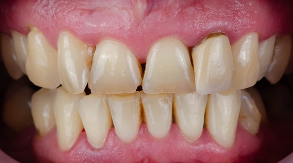 Que causa los dientes desgastados