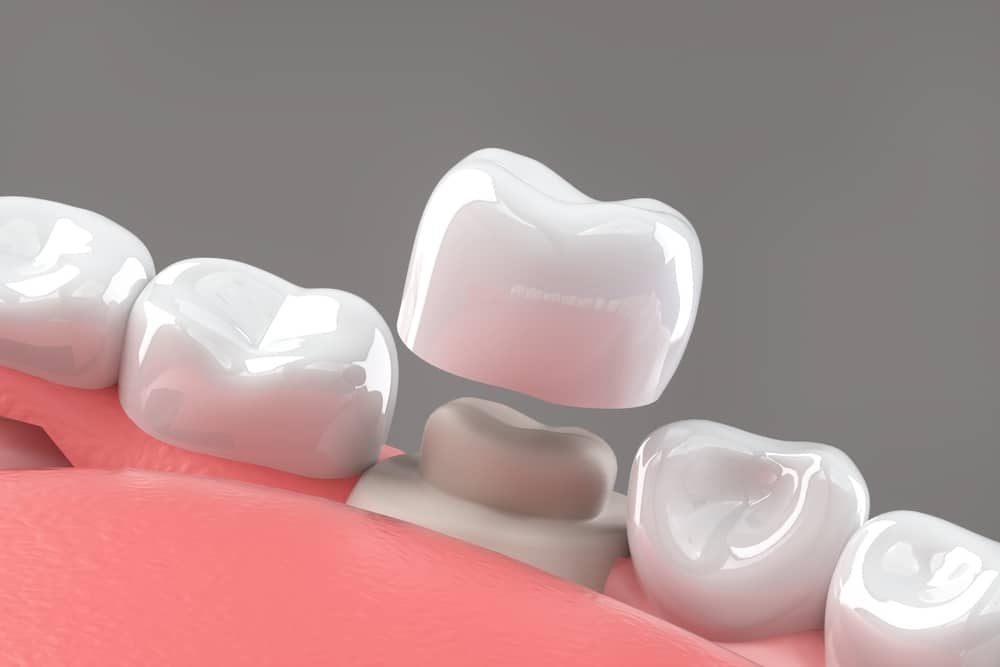 ¿Qué tipos de fundas dentales hay?