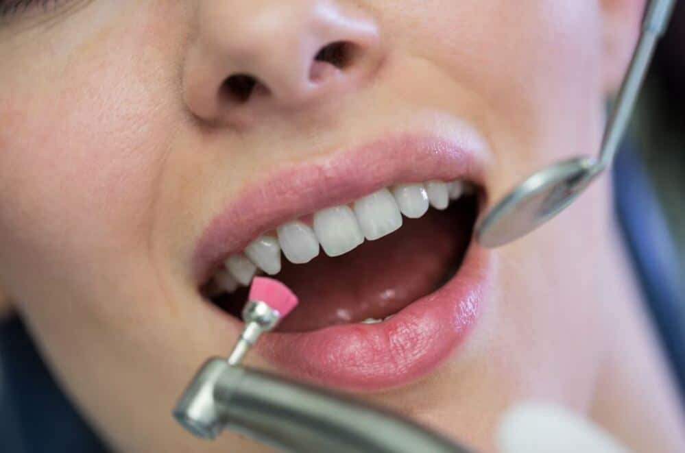 El blanqueamiento dental es bueno o malo