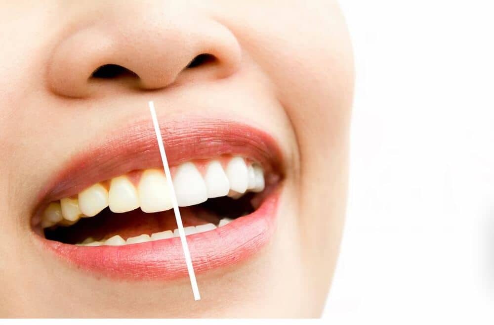 Tu blanqueamiento dental en Domus Dental