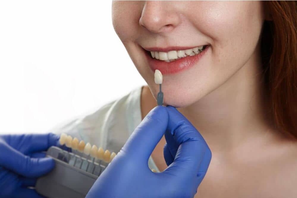 Principales diferencias entre carillas y coronas dentales