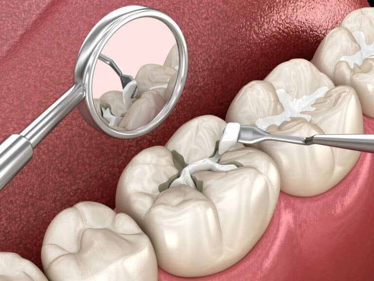¿Cuál es la diferencia entre empaste y reconstrucción dental? Domus