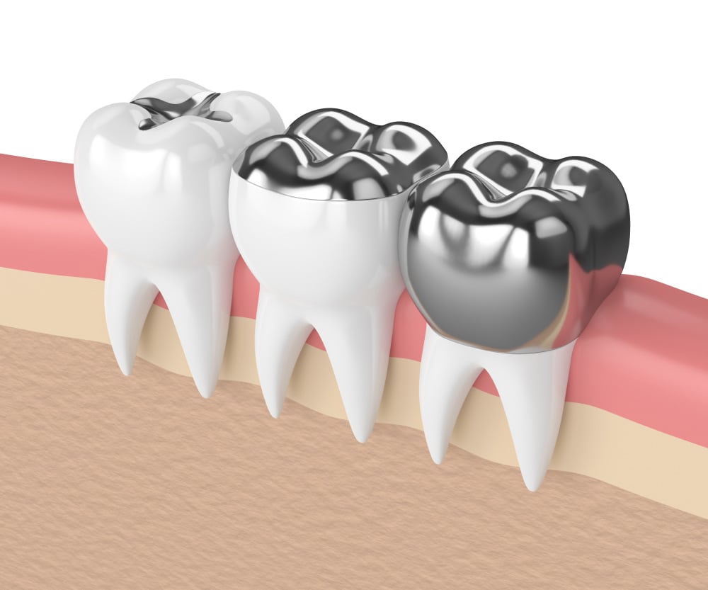 Tipos de incrustaciones dentales en funcion del material