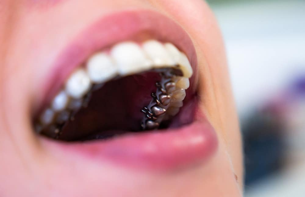 Que es la ortodoncia lingual en Domus Dental