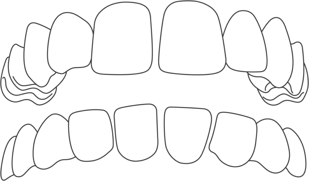 dientes separados 1200x705 1