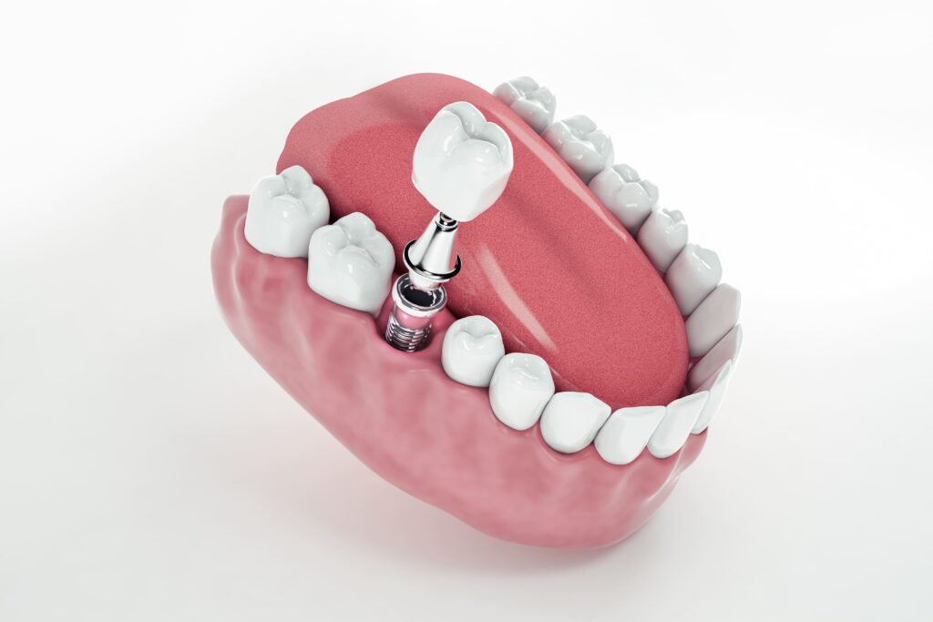 vista arriba implante diente postizo fijado mandibula 3d ilustracion 3d 1
