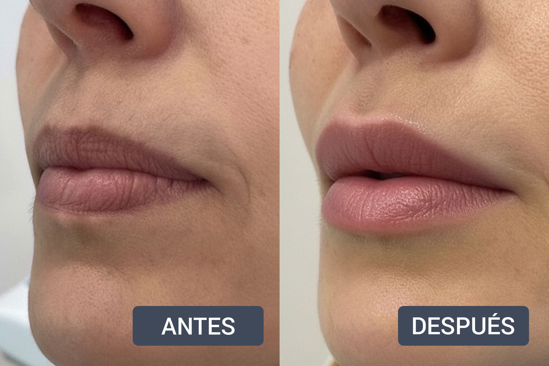 armonizacionlabial antesydespues